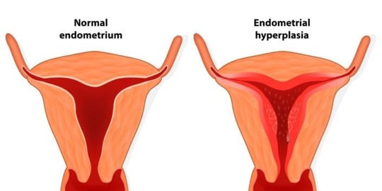 menstruasi-proses-alami-wanita-dan-pentingnya