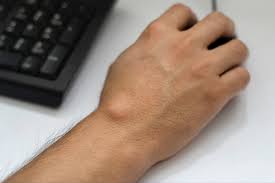 Ganglion Cyst