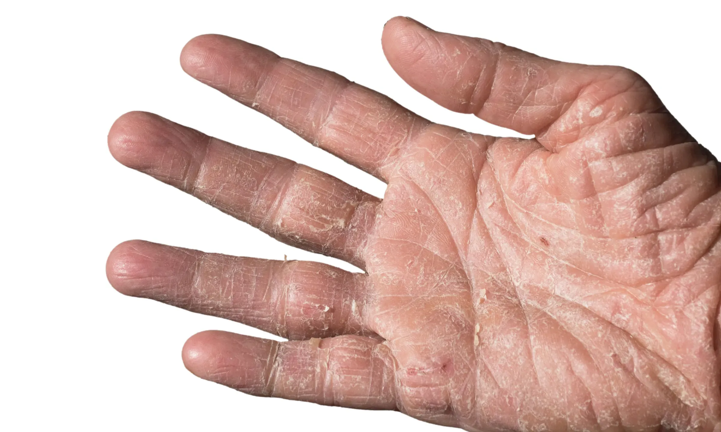 Actinic Keratosis