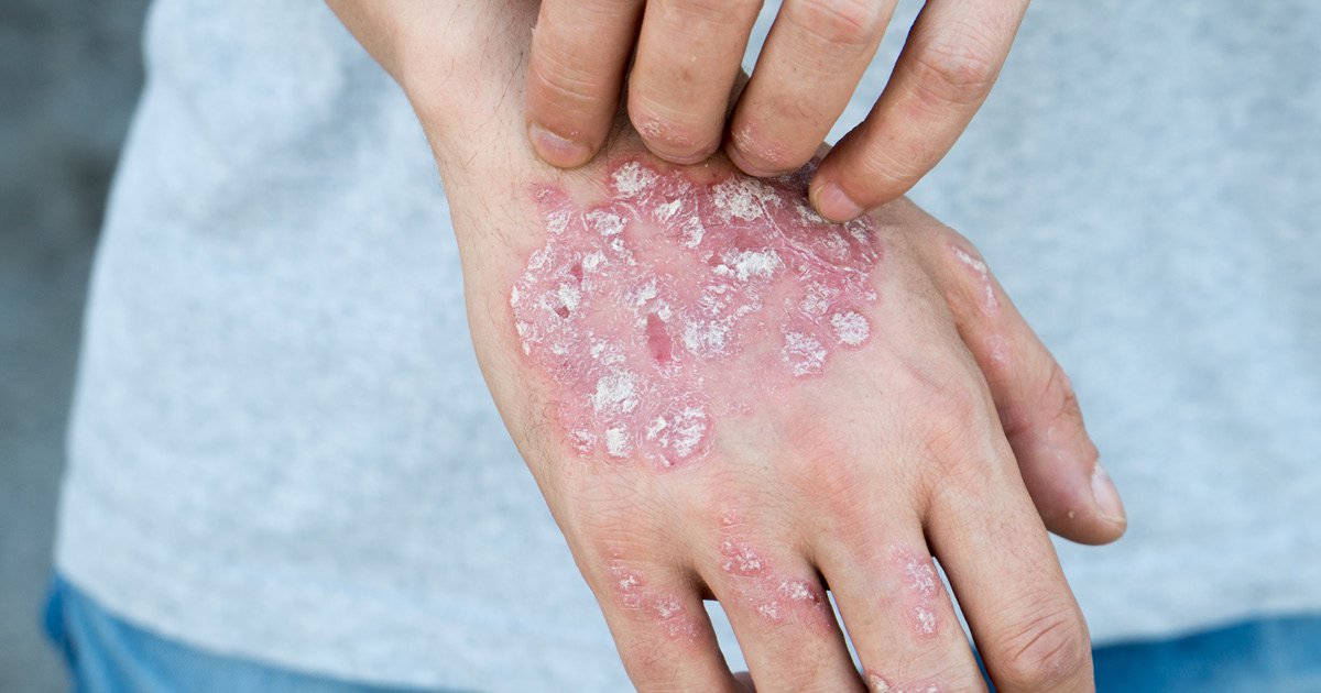 Actinic Keratosis