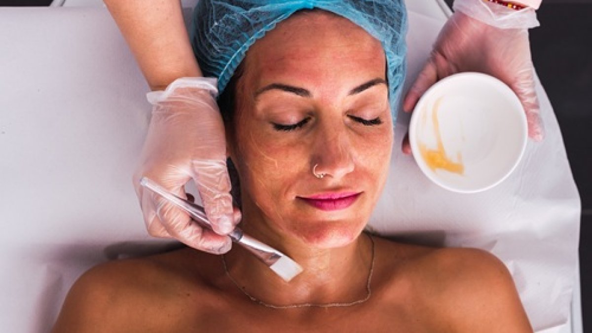 Chemical Peels