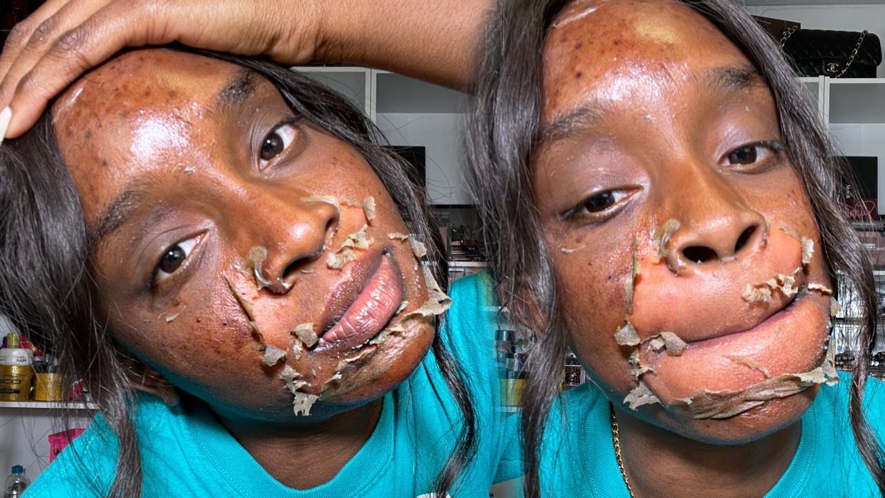 Chemical Peels