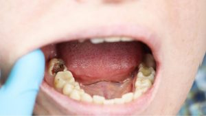 Gigi Berlubang: Masalah Kecil yang Bisa Menjadi Bencana Besar