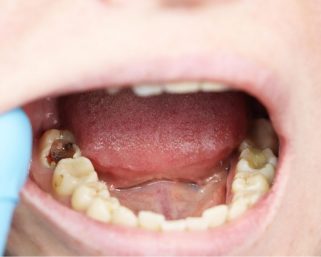 Gigi Berlubang: Masalah Kecil yang Bisa Menjadi Bencana Besar