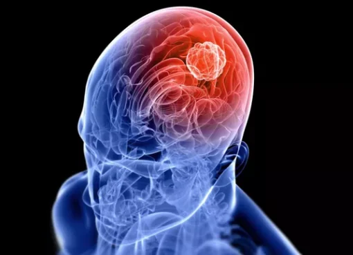 Gejala Tumor Otak