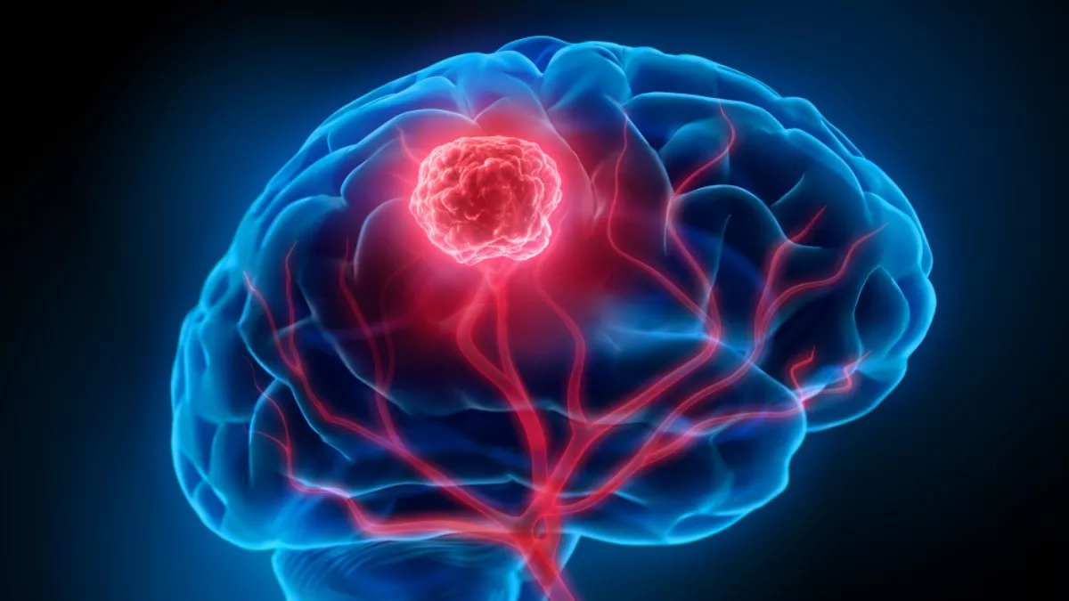 Gejala Tumor Otak