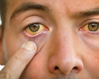 Mengenal Penyebab penyakit mata kuning dan Cara Mengatasinya