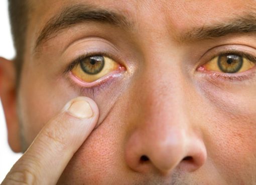 Mengenal Penyebab penyakit mata kuning dan Cara Mengatasinya