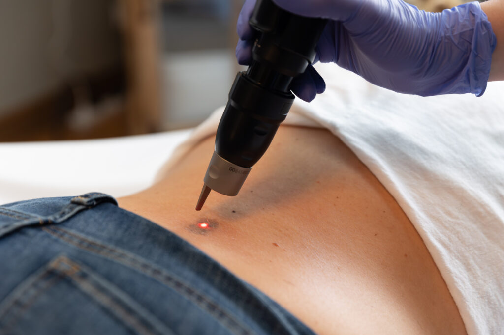 Pico Laser Bagian Tubuh