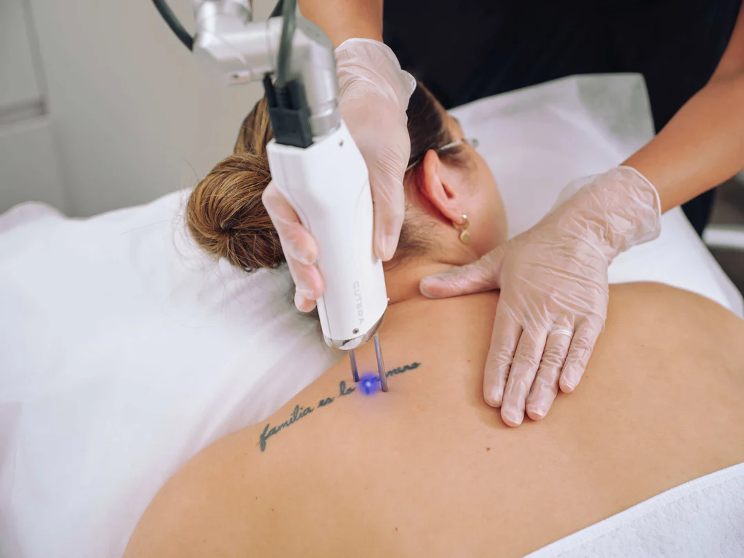 Pico Laser Bagian Tubuh